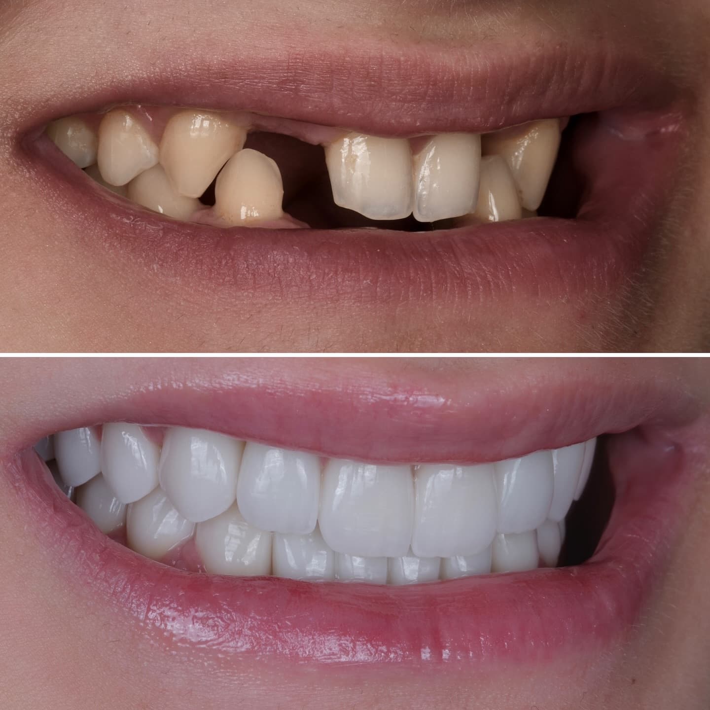 Before and after: implant rehabilitation