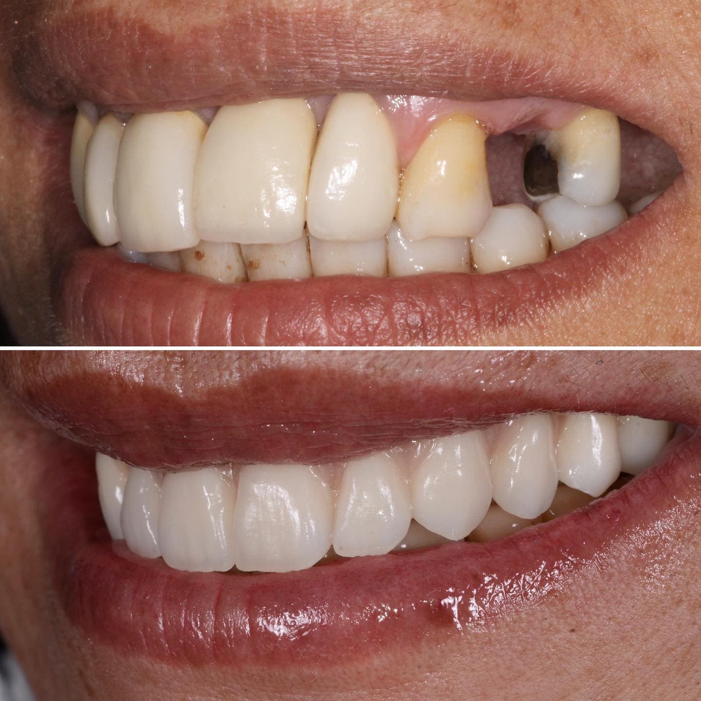 Before and after: implant rehabilitation