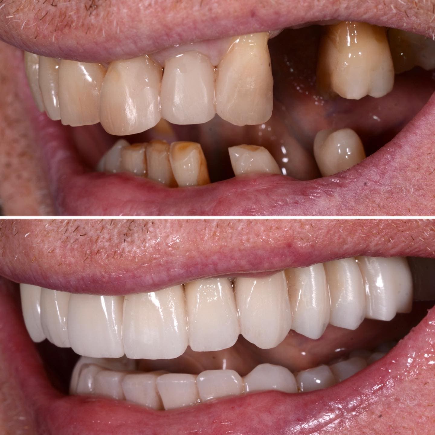 Before and after: implant rehabilitation
