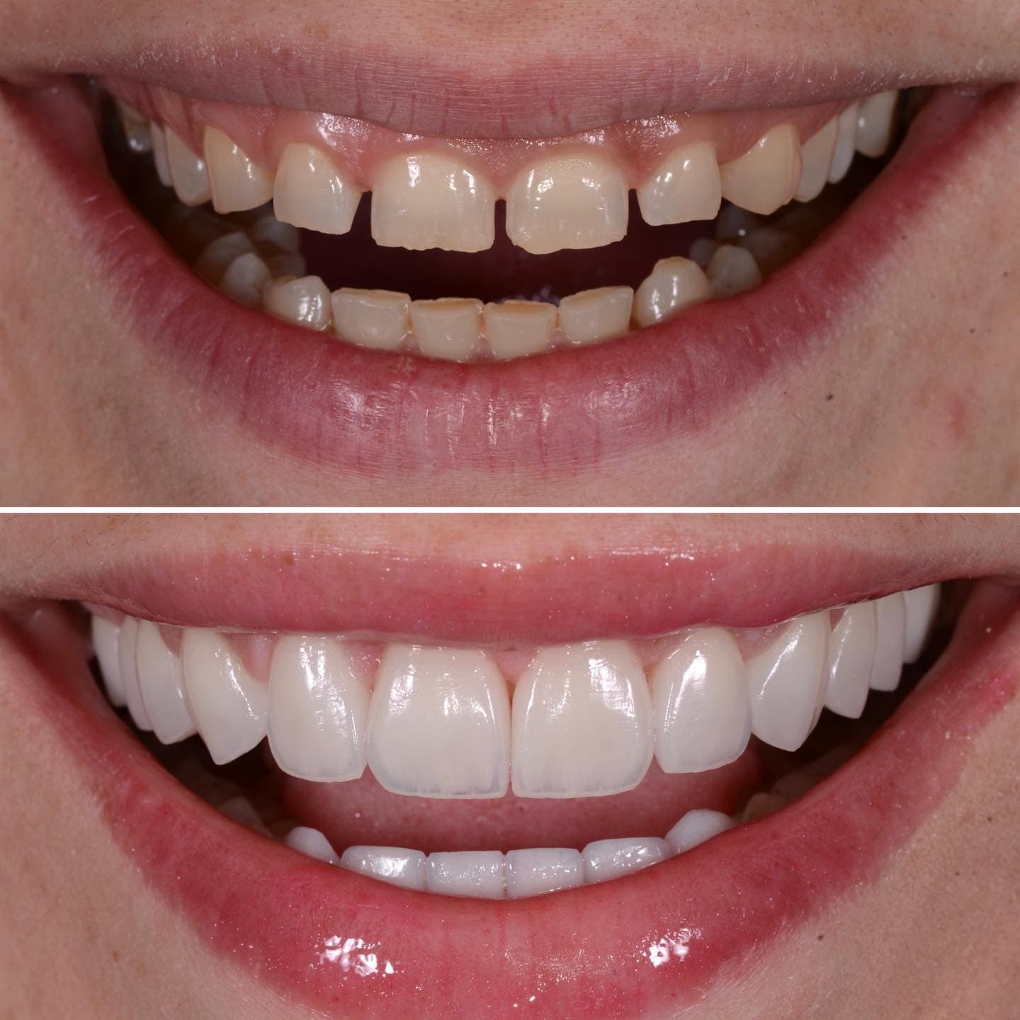 Before and after: smile design