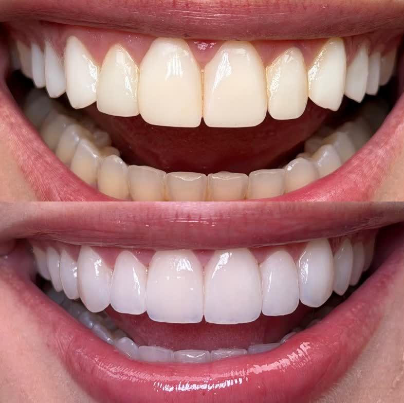 Before and after: smile design