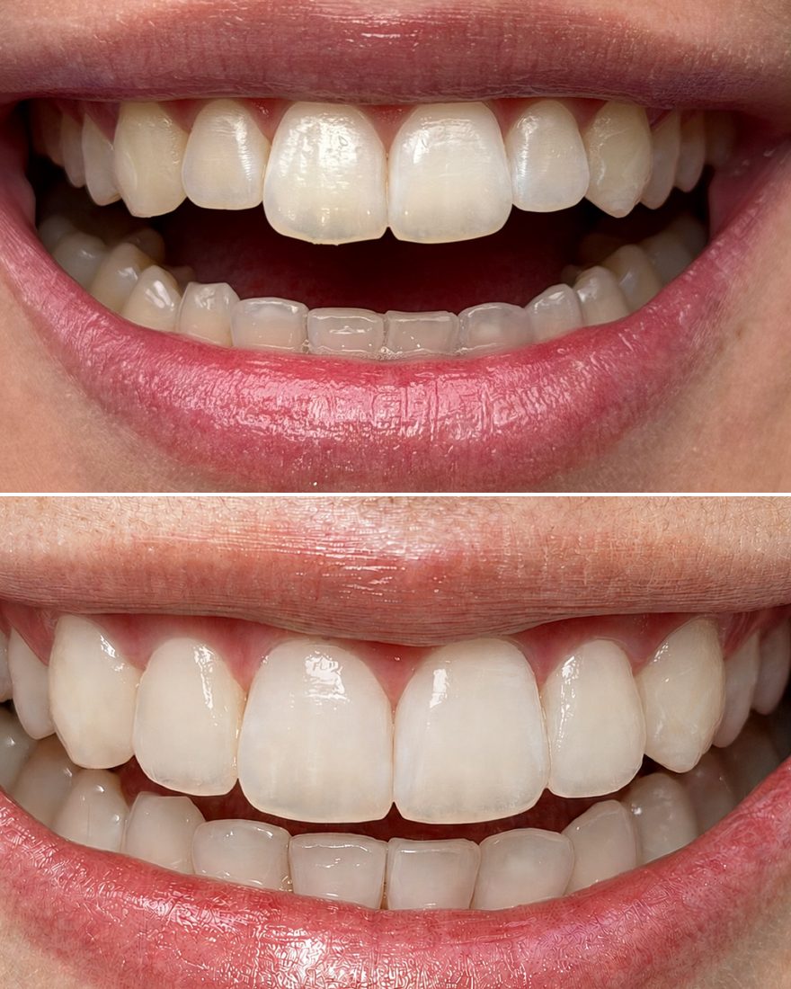 Cosmetic resin bonding