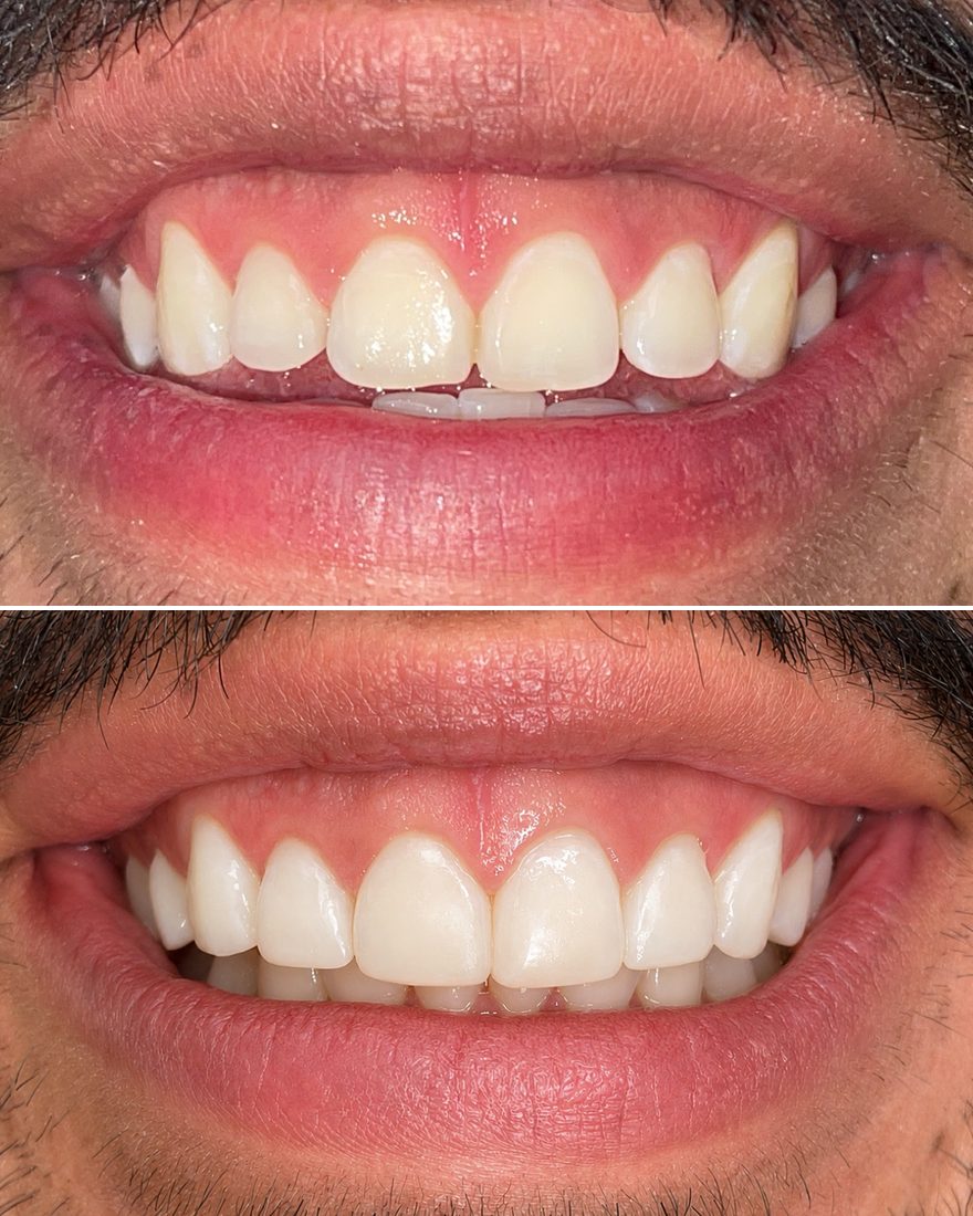Before and after: cosmetic bonding