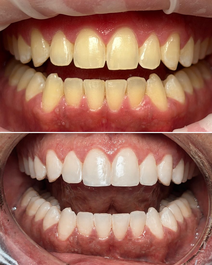 Cosmetic resin bonding