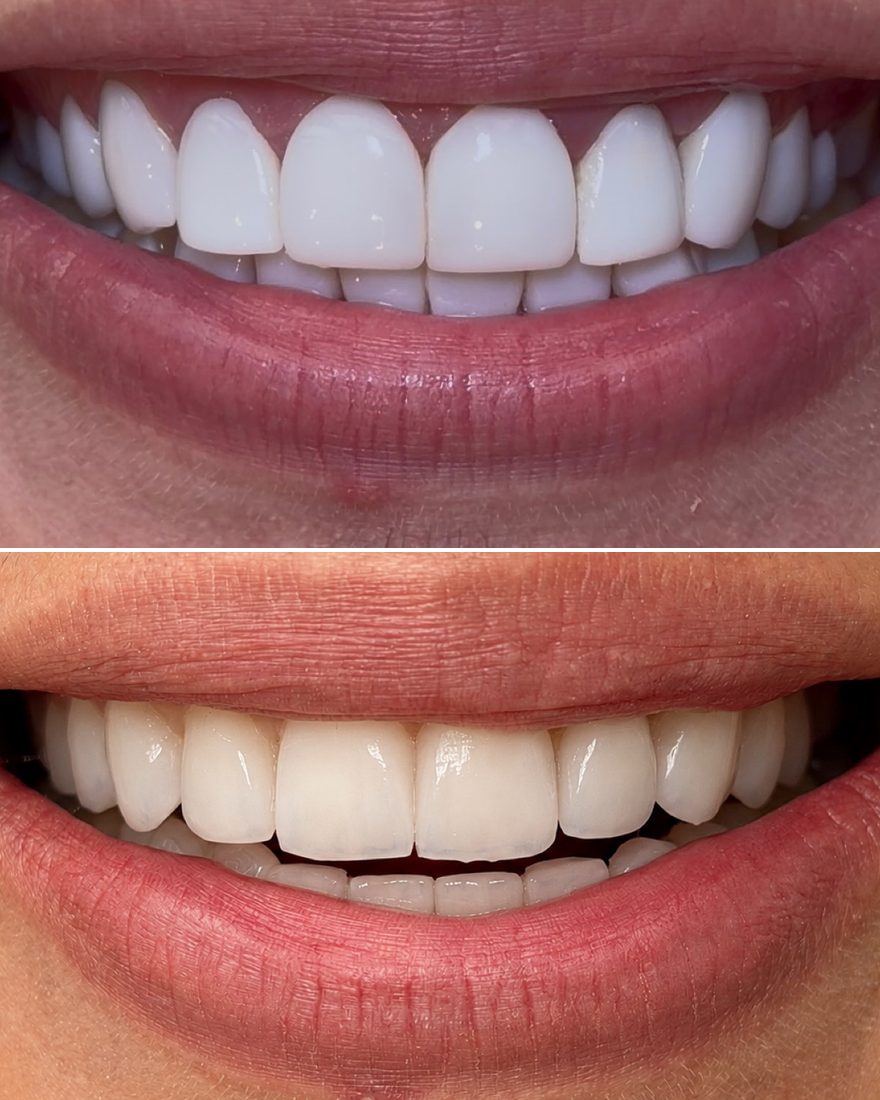 Before and after: ceramic veneers