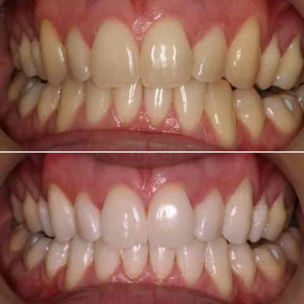 Photo: before & after · whitening