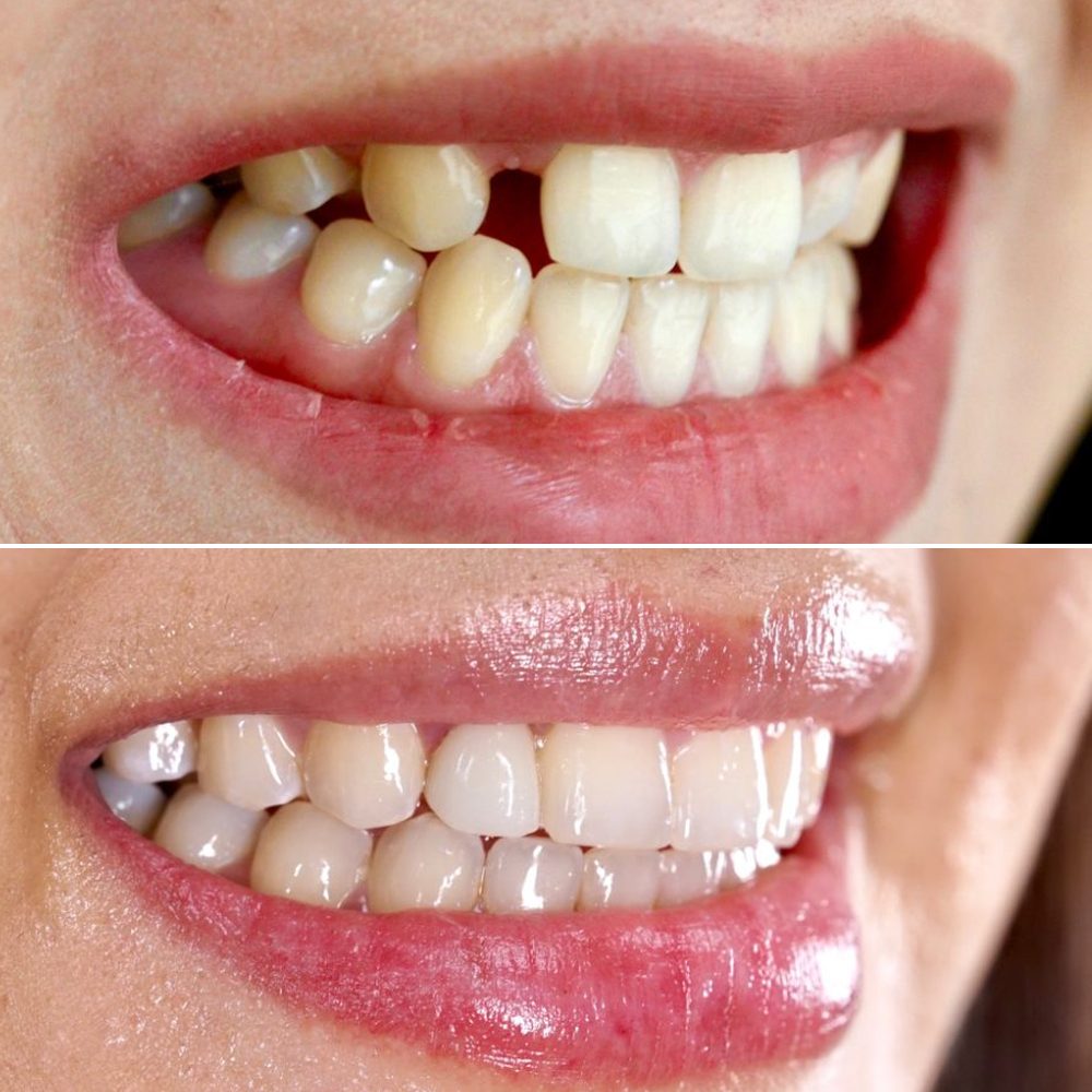 Photo: before & after · implants
