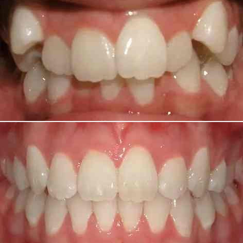 Photo: before & after · orthodontics