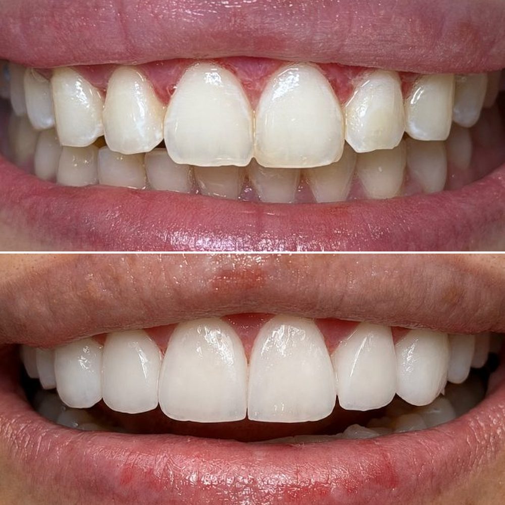 Photo: before & after · smile design