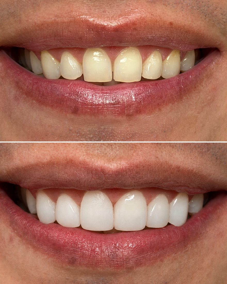 Dental veneers